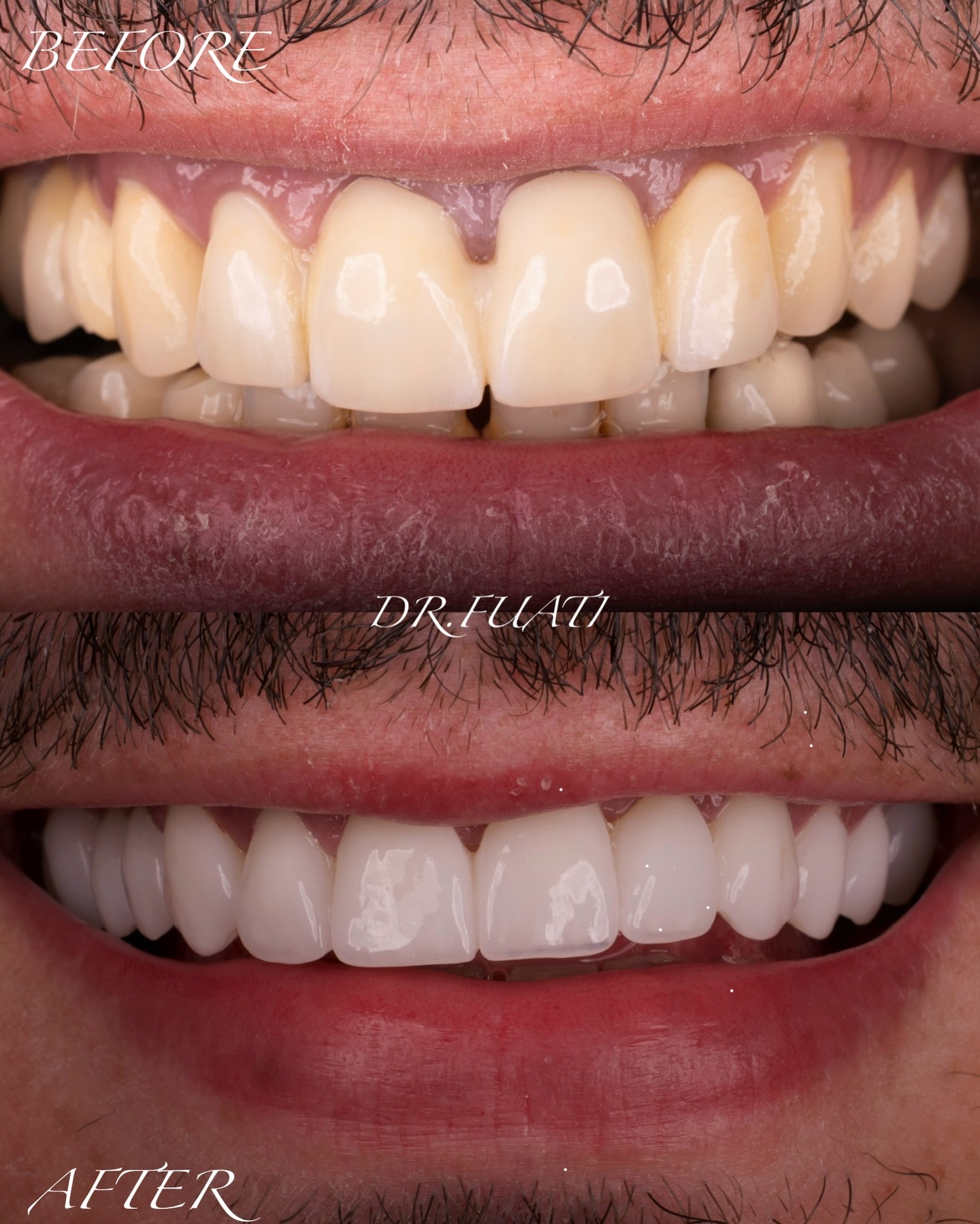 E.max aesthetic rehabilitation